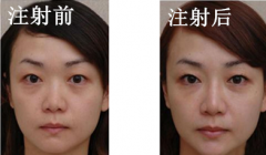 成都米兰整形医院注射隆鼻多少钱?