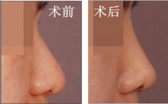 深圳阳光整形美容医院做耳软骨隆鼻多少钱?