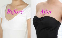 北京航空总医院哪个医生做假体隆胸技术好?