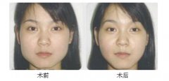 北京圣嘉新整形医院张笑天做磨骨多少钱?