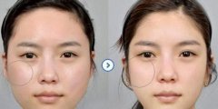 上海华美整形医院李志海磨骨改脸型多少钱?