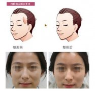 上海美联臣整形医院丰太阳穴怎么样?好不好?