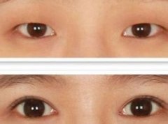上海首尔丽格做韩式双眼皮多少钱？