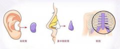 上海华美谢卫国做自体软骨隆鼻多少钱?