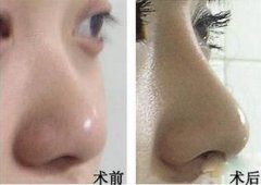 上海美莱整形医院做隆鼻多少钱?好不好?