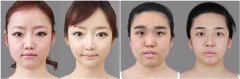 上海首尔丽格做磨骨哪个专家好？朴兴植、洪性