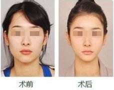 上海美联臣整形医院做磨骨多少钱?怎么样?