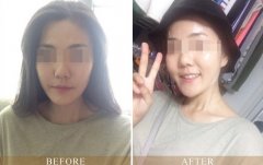 北京东方和谐整形医院做自体脂肪丰苹果肌多少