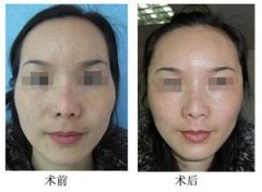 沈阳百嘉丽整形医院自体脂肪丰太阳穴多少钱?