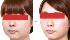 北京凯润婷(原史三八)整形医院面部吸脂多少钱