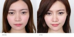 北京凯润婷(原史三八)整形医院垫下巴多少钱?