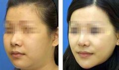 上海玫瑰整形医院做面部吸脂多少钱?怎么样?