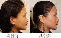上海玫瑰整形医院注射隆鼻多少钱?怎么样?