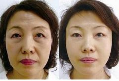 上海玫瑰整形医院面部除皱怎么样?多少钱?