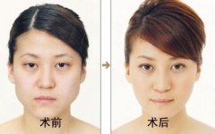 上海华美整形医院李志海做磨骨多少钱?好不好