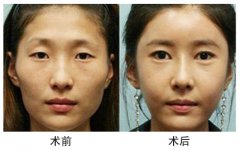 上海伊莱美整形医院做自体脂肪丰太阳穴多少钱