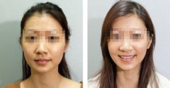 上海美联臣整形医院注射美白针多少钱?好不好