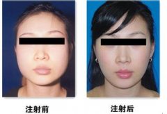 上海美联臣整形医院注射瘦脸针多少钱?好不好