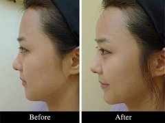 中国鼻祖南京定制中心做隆鼻多少钱?贵不贵?