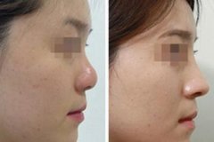 中国鼻祖南京定制中心做假体隆鼻多少钱?怎么样