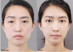 苏州爱思特整形医院做双眼皮修复怎么样?多少钱