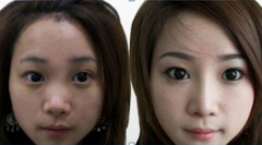 苏州爱思特整形医院做隆鼻多少钱?怎么样?