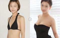 杭州格莱美整形医院做假体隆胸怎么样?多少钱
