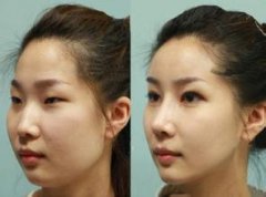 大连沙医生整形医院做隆鼻多少钱?怎么样?