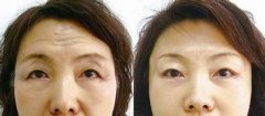 大连沙医生整形医院去抬头纹多少钱?怎么样?
