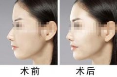 长沙爱思特整形医院假体垫下巴多少钱?怎么样