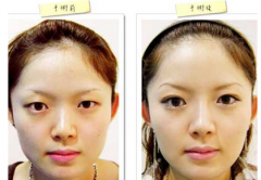 合肥韩美整形医院做韩式双眼皮多少钱?怎么样