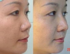 美莱整形医院牛永敢做硅胶隆鼻多少钱?怎么样