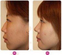 鼻部整形术前后注意事项有哪些?