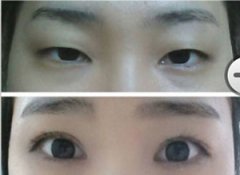 做双眼皮手术后如何护理?