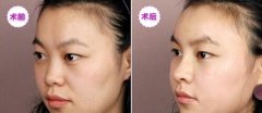隆鼻失败修复有哪些方法?