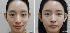 自体脂肪填充多少钱?价格是多少?