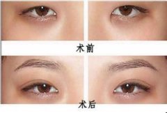 埋线双眼皮一般需要多少钱?