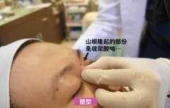 注射玻尿酸隆鼻的效果能维持多久?价格是多少