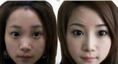 玻尿酸隆鼻有副作用吗?