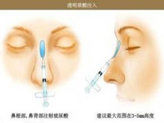 注射隆鼻能维持多久？需要多少钱？