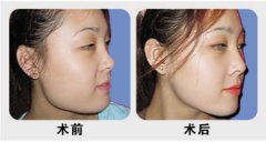 下颌骨整形手术危险吗