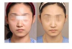 瘦脸整形有后遗症吗?