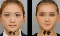 磨骨瘦脸的过程是怎样的?