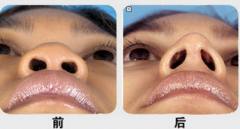 垫鼻尖的危害有哪些?