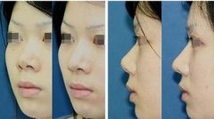 朝天鼻矫正手术危险吗