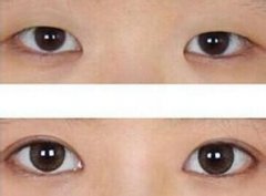 韩式微创双眼皮是什么？