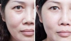 自体脂肪丰脸颊效果好吗