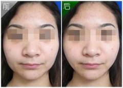 咬肌切除整形手术效果好吗?