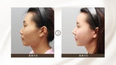常见的隆鼻方法？