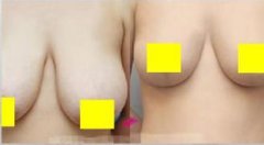 乳房下垂方法有哪些？